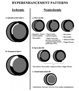 図1　各疾患における遅延造影像（LGE）分布パターン　　 文献[2]　より引用